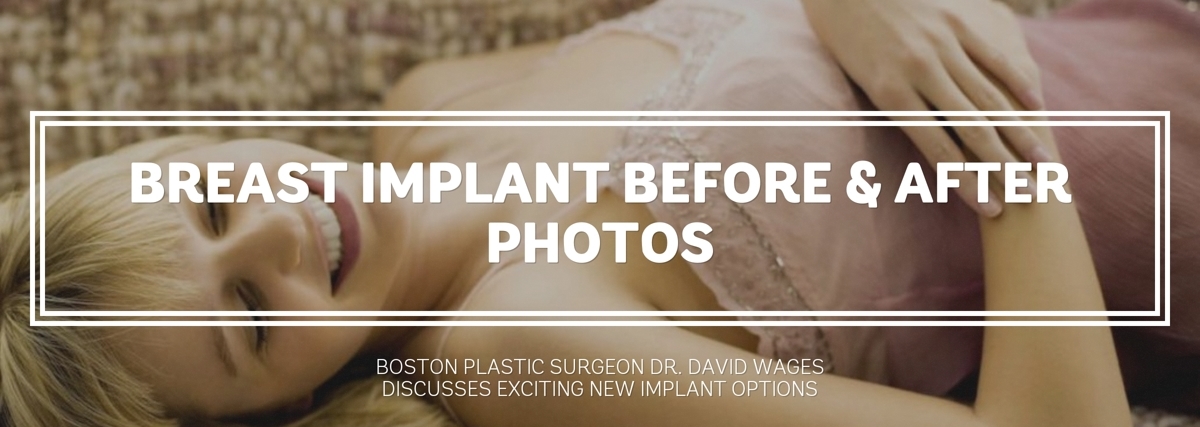 Breast Implants from North Shore Plastic Surgery, Boston Area