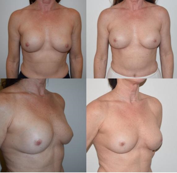 2 - breast implants revision breast augmentation Rapaport