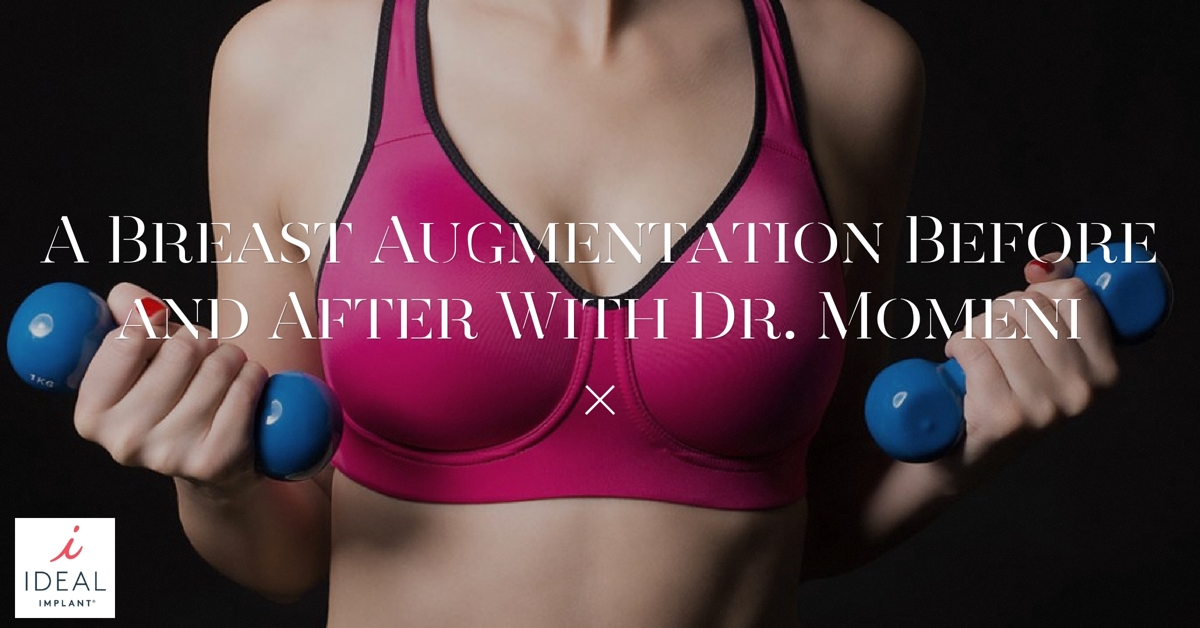 A Breast Augmentation, Before and After, With Dr. Momeni