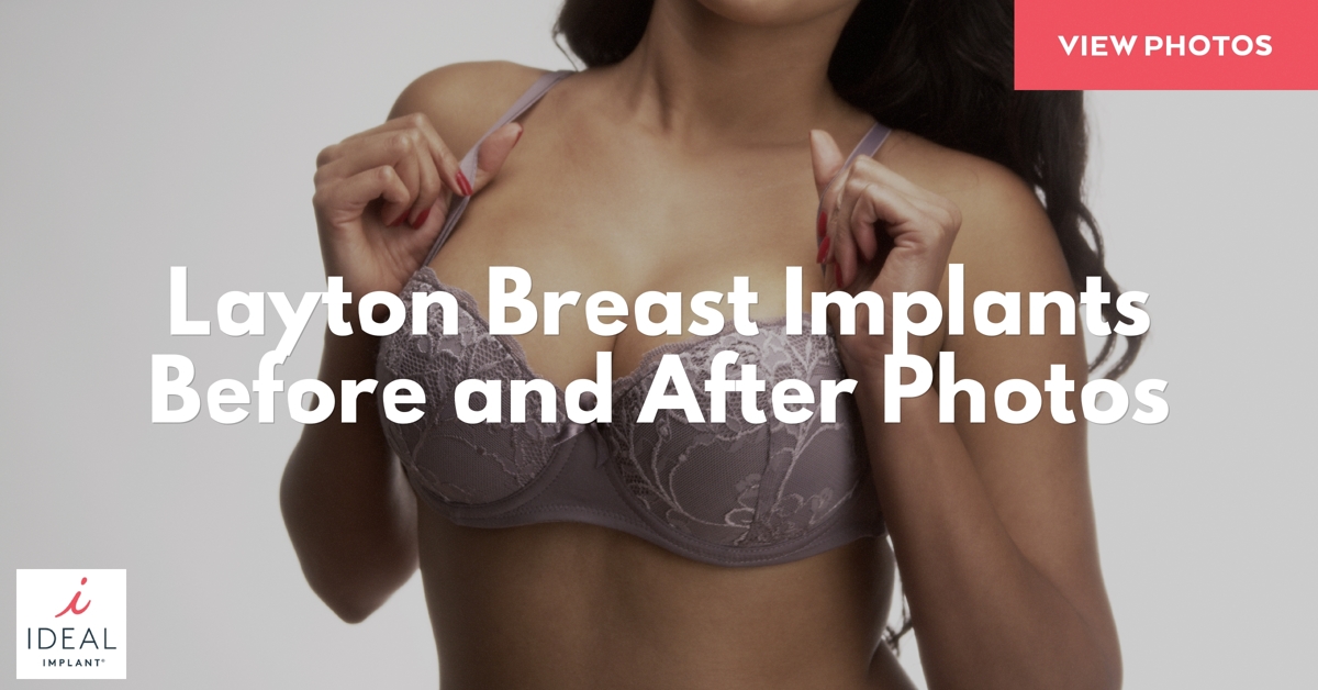 Layton Breast Implants Before and After Photos
