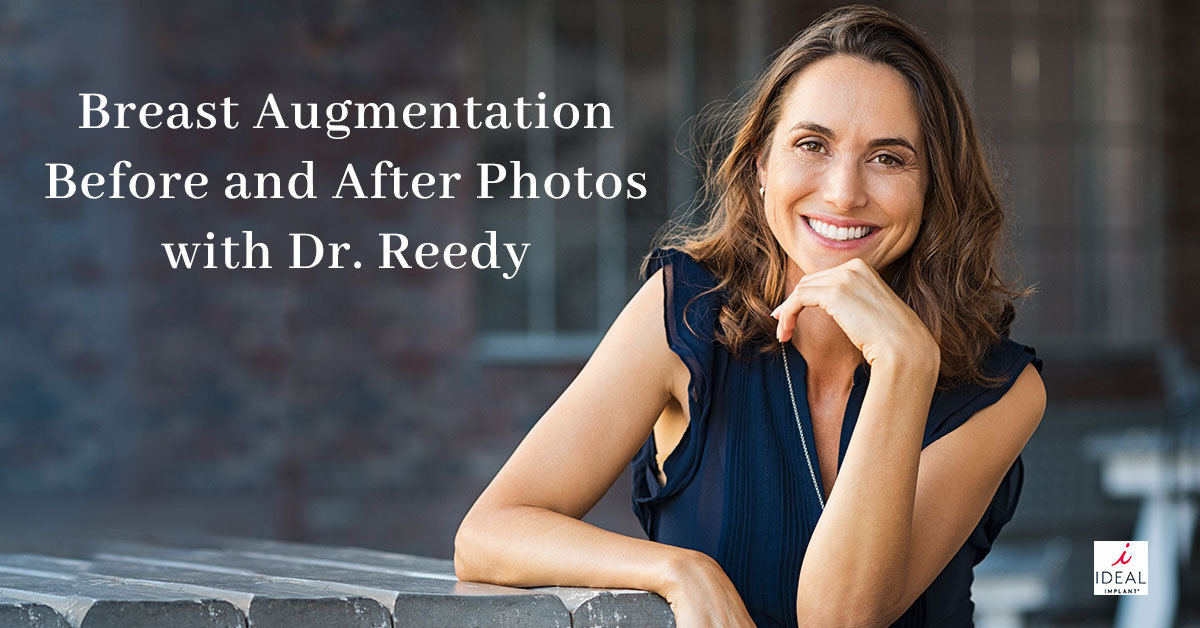 Breast Augmentation Before and After Photos with Dr. Reedy