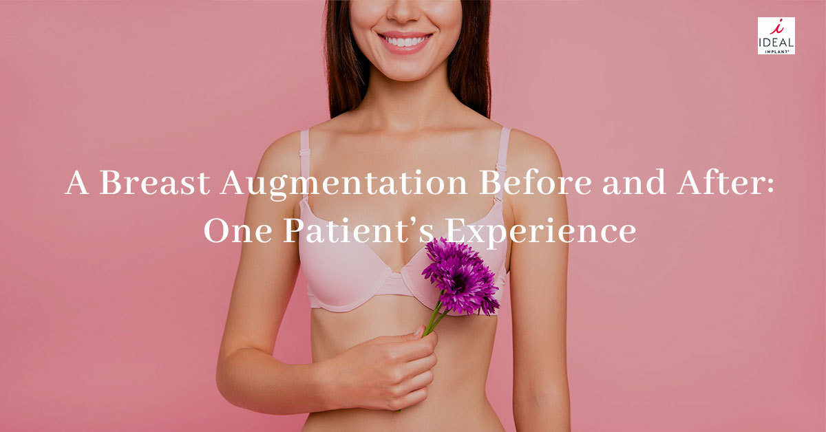A Breast Augmentation Before and After: One Patient’s Experience