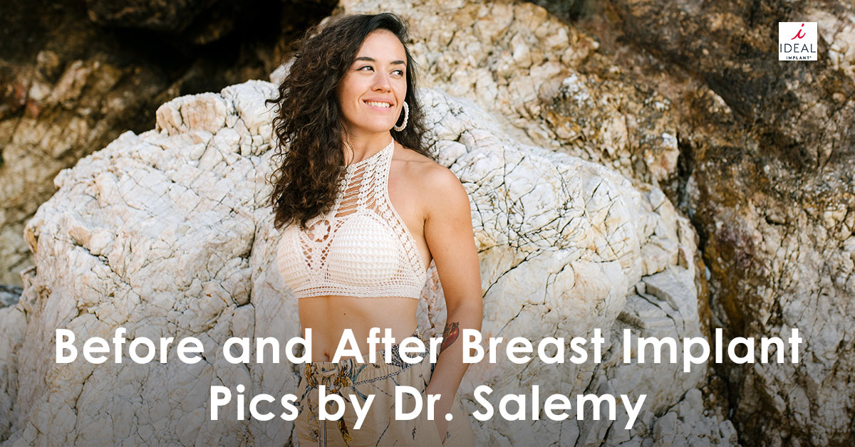 Before and After Breast Implant Pics by Dr. Salemy