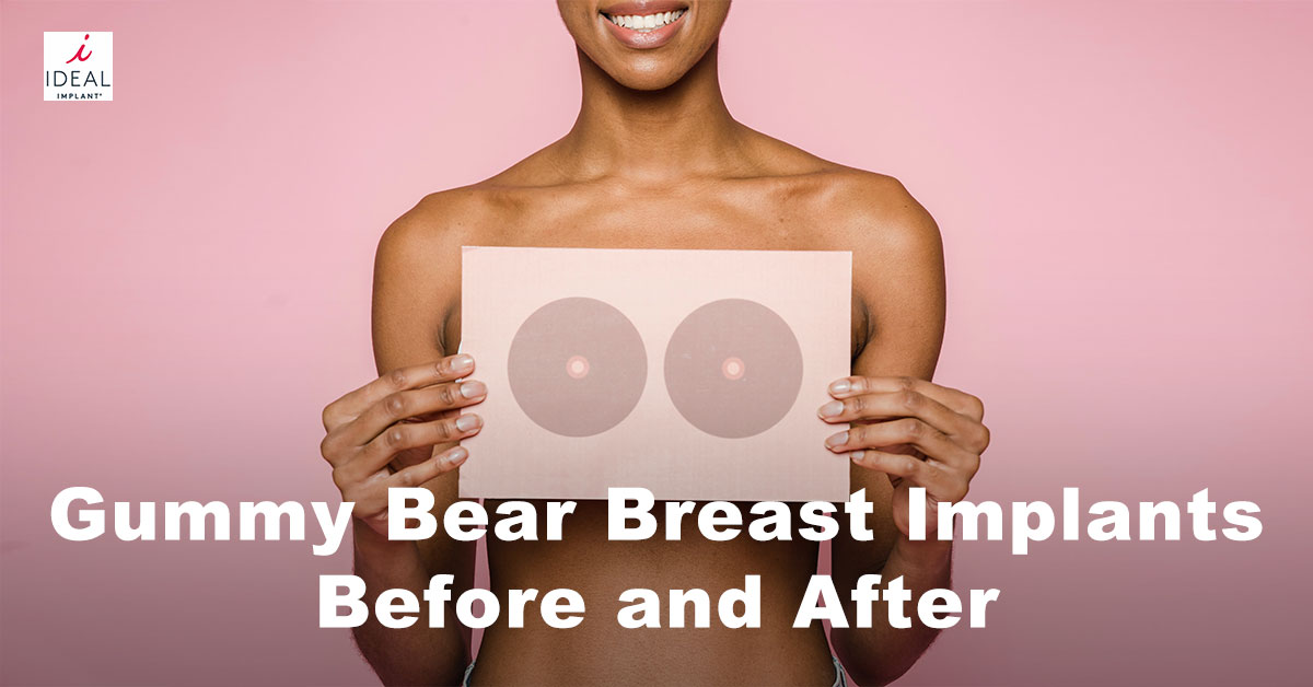 Gummy Bear Breast Implants Before and After