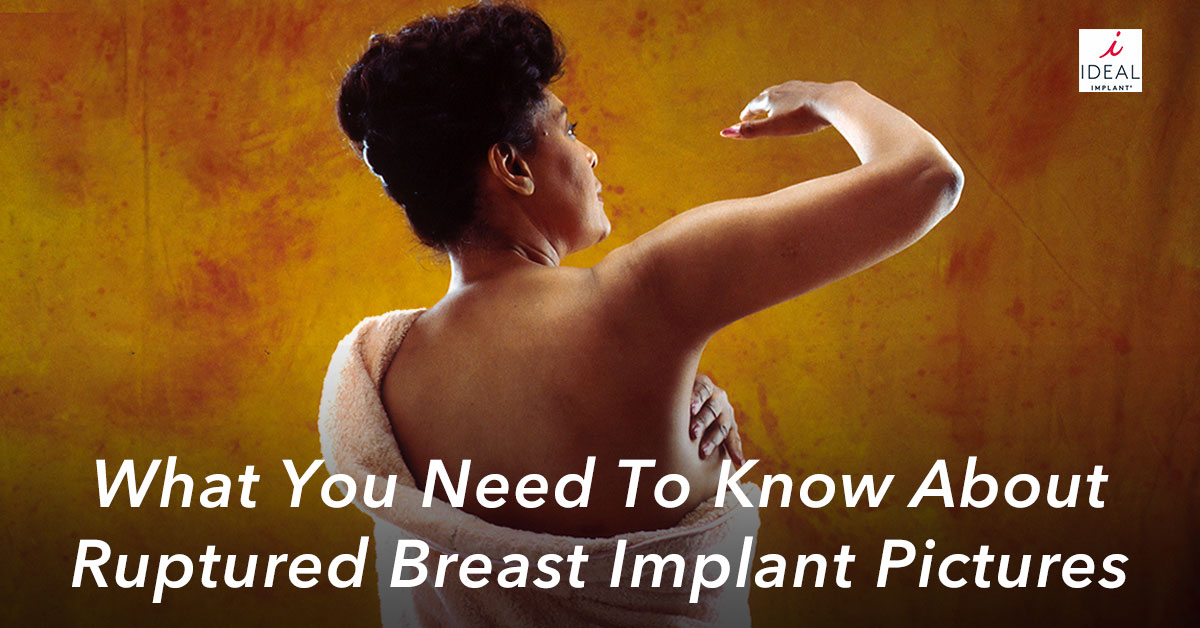 What You Need to Know About Ruptured Breast Implant Pictures