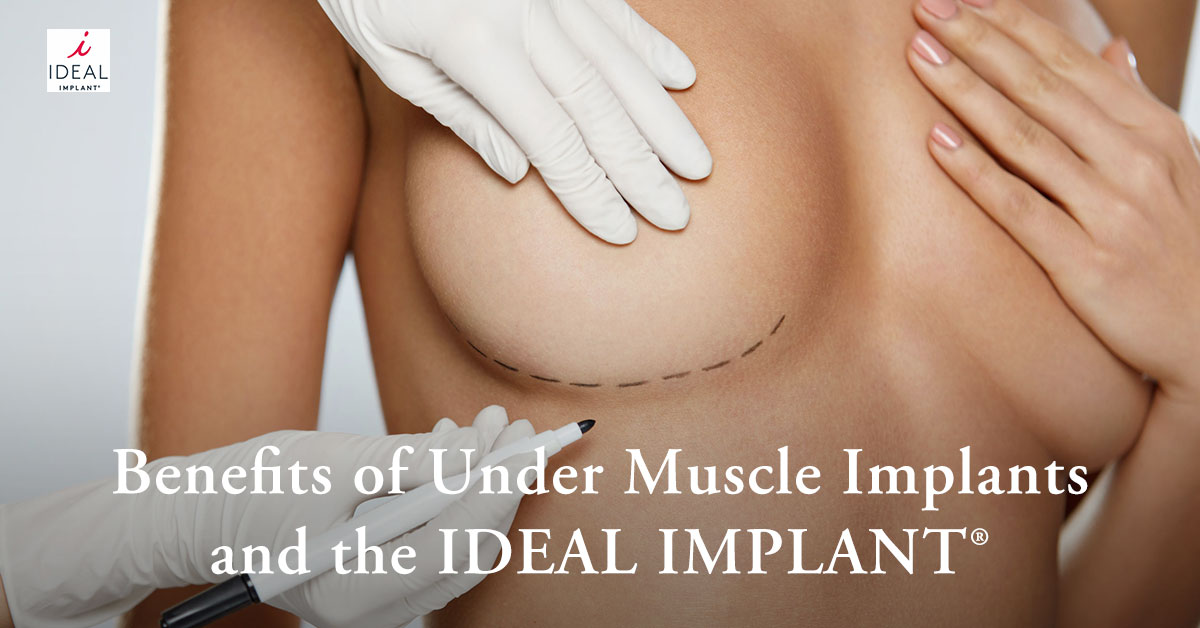 Benefits of Under Muscle Implants and the IDEAL IMPLANT®